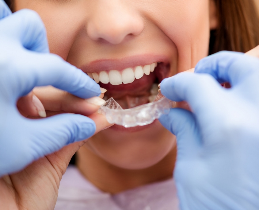 invisible braces orthodontist checking kids-dental-braces-downtown vancouver dentist