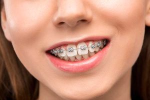 Early Orthodontic Evaluations for Children