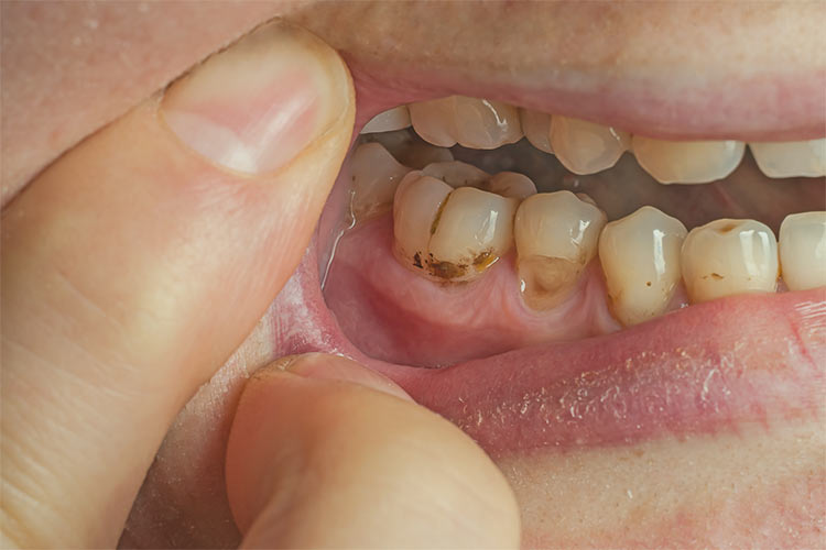 Plaque Between Teeth