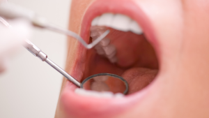 Full dental exams in Downtown Vancouver at O2 Dental clinic