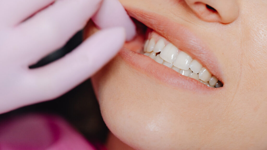 Tooth decay at the gum line close-up