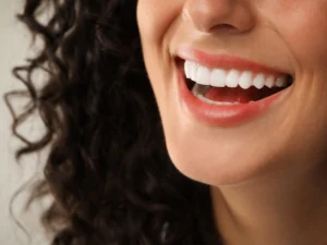 Porcelain veneers smile transformation at O2 Dental Vancouver